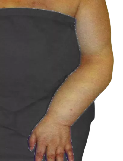 Modul 3 - KDT nakon karcinoma dojke