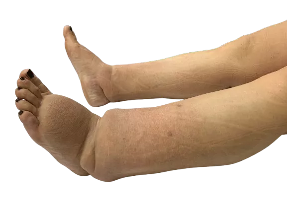 Modul 4 - KDT nakon abdominalnih karcinoma